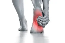 Plantar fasciitis